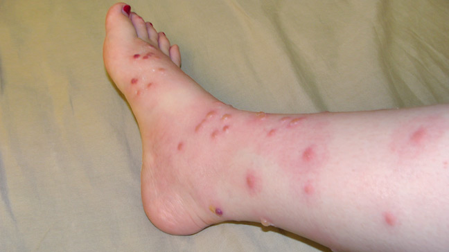 648x364-Poison_Oak_Rash-1.jpg